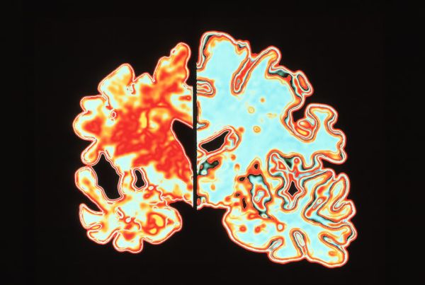Memory Loss / Dementia / Alzheimer