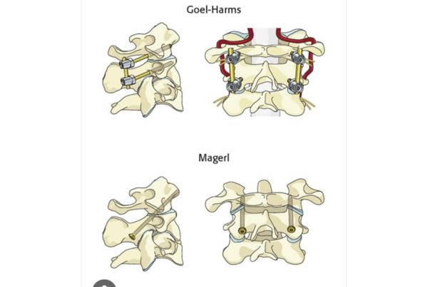 Craniovertebral Junction Anomaly