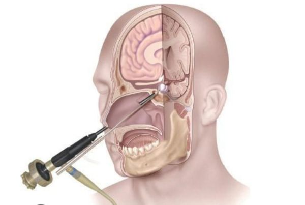 Endoscopic Brain Surgery